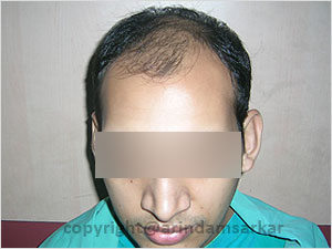 Hair Transplant