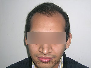 Hair Transplant