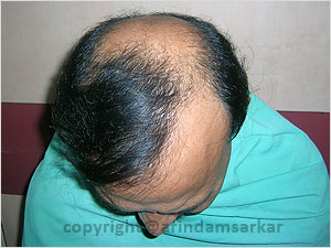 Hair Transplant