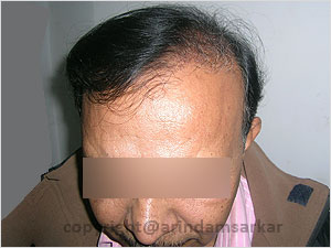 Hair Transplant