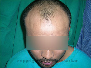 Hair Transplant