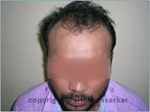 Hair Transplant