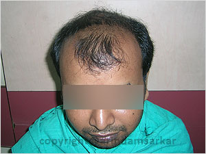 Hair Transplant