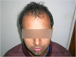 Hair Transplant