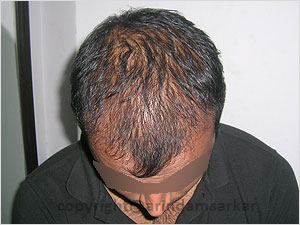 Hair Transplant