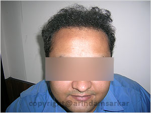 Hair Transplant