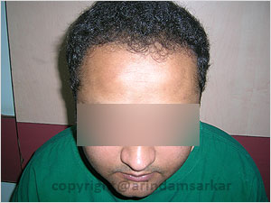 Hair Transplant