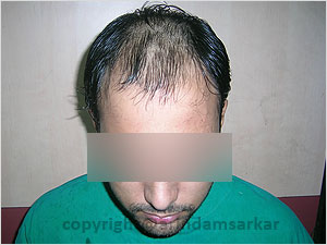 Hair Transplant