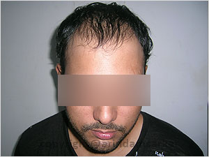 Hair Transplant