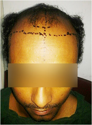 Hair Transplant