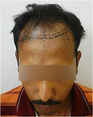 Hair Transplant