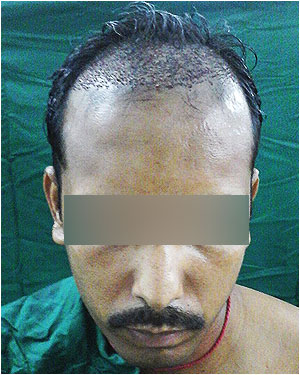 Hair Transplant