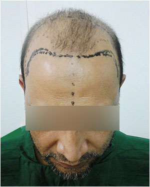 Hair Transplant