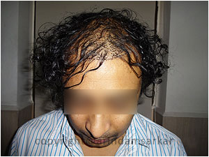 Hair Transplant