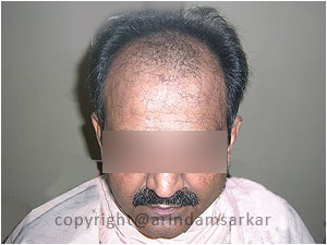 Hair Transplant