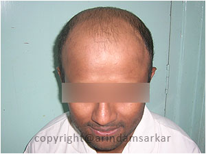 Hair Transplant