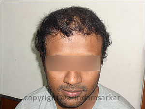 Hair Transplant