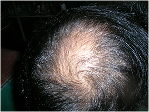 Hair Transplant