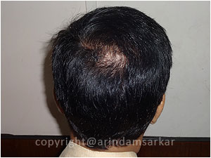 Hair Transplant