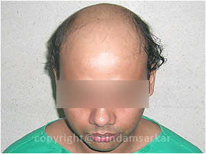 Hair Transplant