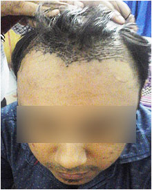 Hair Transplant