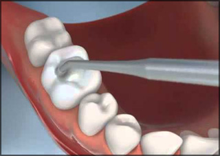 Cavity Fillings