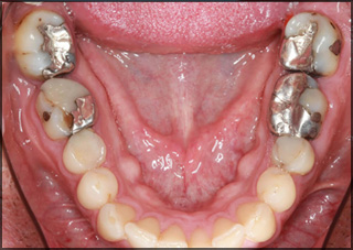 Cavity Fillings