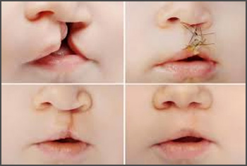cleft lip & palate