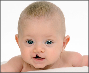 cleft lip & palate
