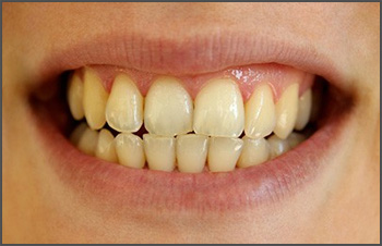 Tooth Discolorization