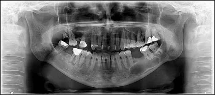 jaw cysts