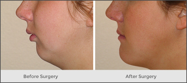 orthognathic surgery