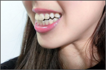 Protruded Teeth