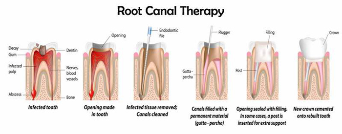 Root Canal Treatment