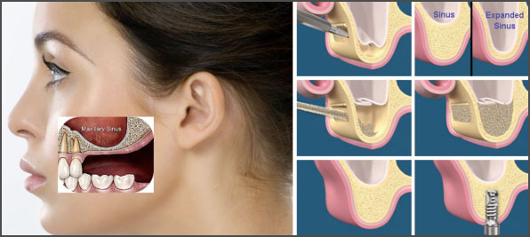 sinus augmentation