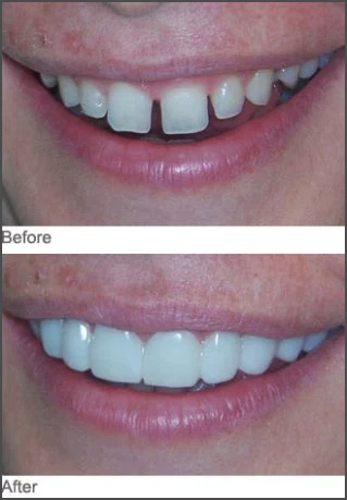 Closing the Gap between Teeth