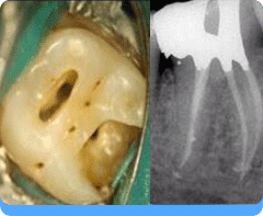 Endodontics - Root Canal Treatment