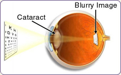 cataract