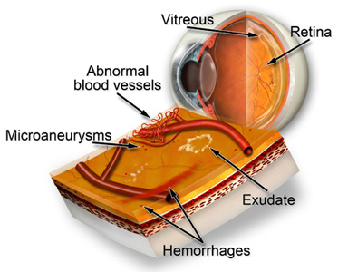 diabetic retinopathy