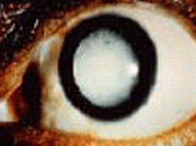 cataract