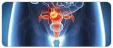Uterine & Endometrial Cancer