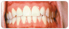 Gum Cancer