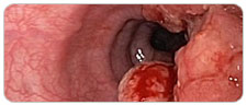 Oesophageal Cancer