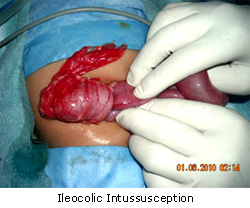 Ileocolic Intussusception