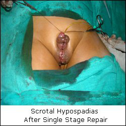 Hypospadiasn