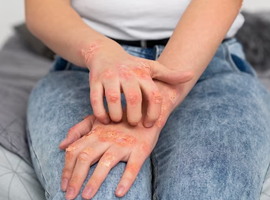 Psoriasis