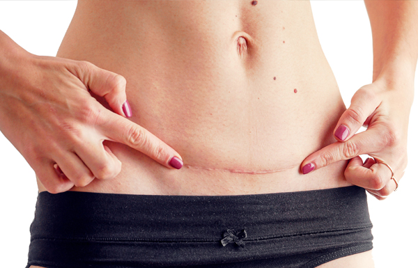 Scar Endometriosis Surgery in Kolkata India