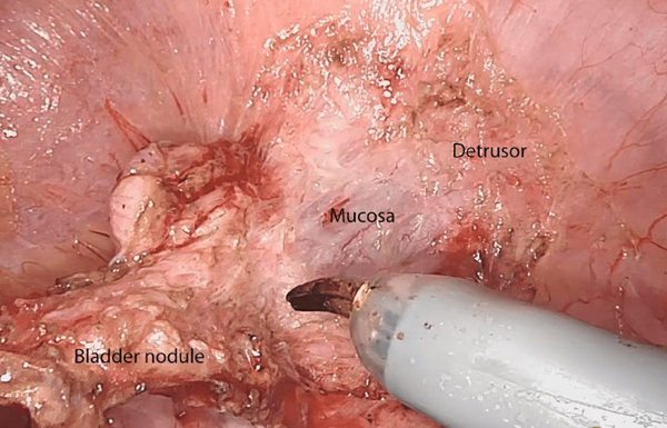 Bladder Endometriosis Surgery in Kolkata India