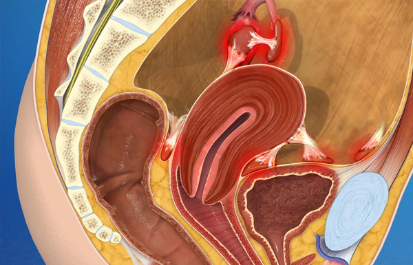 Advanced Endometriosis Surgeon in Kolkata India