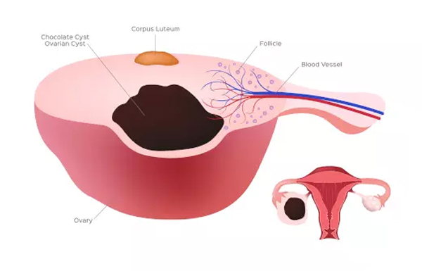 Chocolate Cyst Surgery in Kolkata